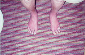Feet after using the ReBuilder Treatment System.