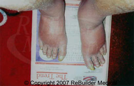 Feet before using the ReBuilder Treatment System.