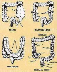 colon, divrticolitis, colitis constipation bowel cleanse