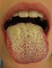 Human tongue infected with oral candidiasis.jpg