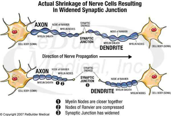 Actual shrinkage of Nerve Cells Resulting in Widened Synaptic Junction